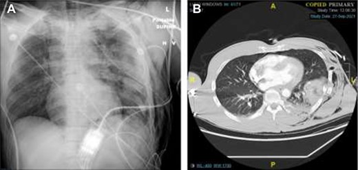 Chest X-Ray and CT imaging showing rib fracture. (A) Chest X-ray and (B) CT showing fractures to the left ribs.