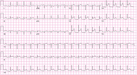 Initial ECG showing ST Elevation anterolateral injury pattern.
