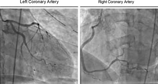 Coronary angiography showing occlusion of the apical left anterior descending artery and stenosis of the second obtuse marginal artery.