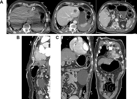 (A) Axial CT-angiogram: side drainage holes are apparent in the pericardium and the abdominal cavity; the drain courses anteriorly and abuts the medial aspect of the liver and stomach ~3 cm superiorly and medially to the course of the drain insertion forming a large loop; free gas is apparent at the right anterior liver; (B) sagittal CT-angiogram: subxiphoid approach with peritoneal entry; (C) coronal CT-angiogram: placement of catheter in pericardium; catheter traverses segment 2/3 liver.