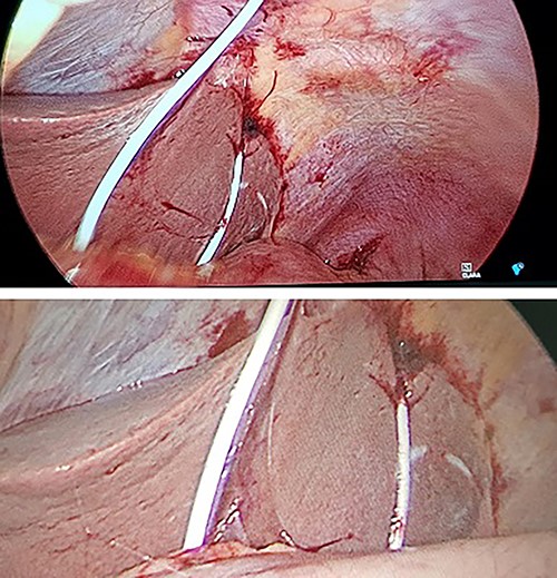 Intraoperative photographs during laparoscopy for removal of intraperitoneal pericardial drain.