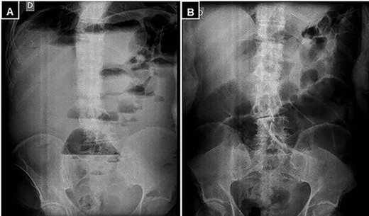 (A) Standing abdominal X-ray, and (B) supine position demonstrating marked distention of the small intestine and multiple air-fluid levels.
