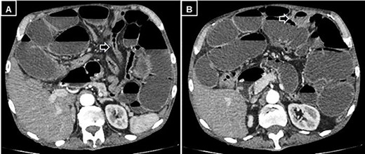 Abdominal and pelvic CT with intravenous contrast. (A) Axial image illustrating a change in caliber (black arrow) with subsequent distension of the small intestine, and (B) a small mesenteric collection (black arrow).
