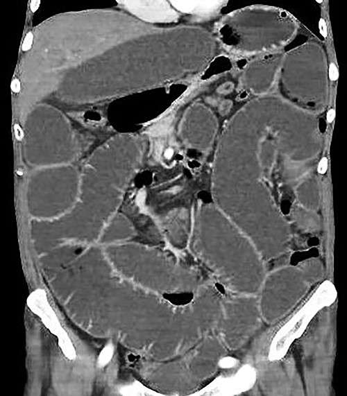 Abdominal and pelvic CT with intravenous contrast. Coronal image illustrating dilated fluid-filled loops of the small intestine consistent with high-grade mechanical obstruction.