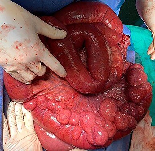 Jejunum segment affected by multiple diverticula located on the mesenteric side of the intestine.