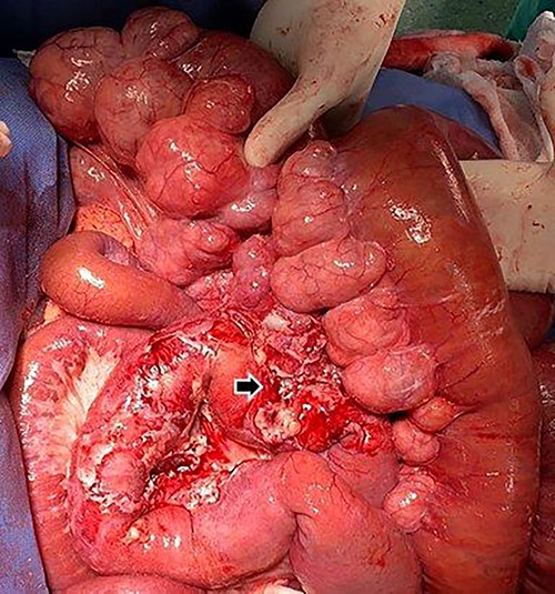 Inflammation of the peridiverticular mesenteric tissue adjacent to the perforated jejunal diverticulum (black arrow).