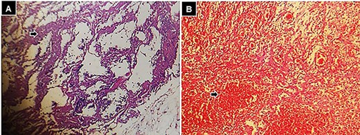 Histological findings following hematoxylin and eosin staining, 10× small bowel, (A) zone of transmural necrosis (black arrow), and (B) intestinal wall with zones of necrosis, and hemorrhage (black arrow).