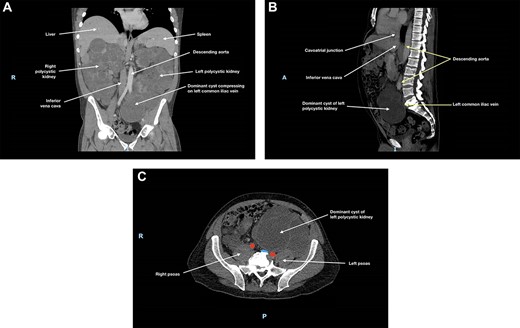 (A) Coronal, (B) sagittal and (C) axial views of the patient’s CT scan of his abdomen and pelvis at initial presentation; this showed enlarged polycystic kidneys, with the left kidney extending into the patient’s pelvis; there was compression of the left common iliac vein by a dominant cyst in the left polycystic kidney against the patient’s sacrum; in (c), the left common iliac vein is depicted in blue and the common iliac arteries are depicted in red; hepatic cysts and duodenal effacement are not visible in the selected planes; R, right; I, inferior; A, anterior; P, posterior.