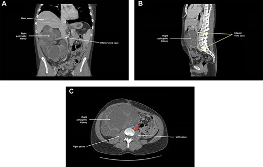 (A) Coronal, (B) sagittal and (C) axial views of the patient’s CT angiogram at 3 months post-left nephrectomy, showing persistent inferior vena cava compression by the right polycystic kidney, with near-complete effacement; in (c), the inferior vena cava is depicted in blue and the descending aorta is depicted in red.