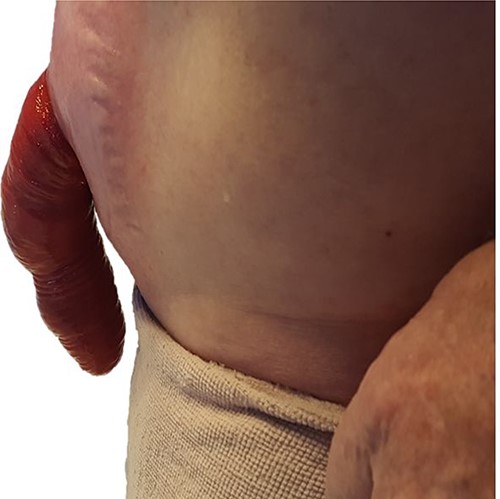 Ileostomy prolapse.