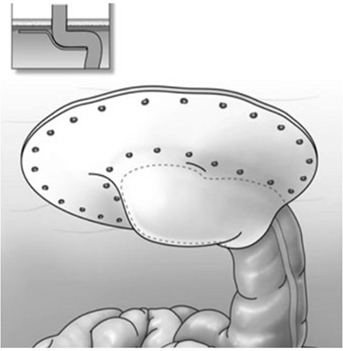 Modified laparoscopic Sugarbaker procedure.
