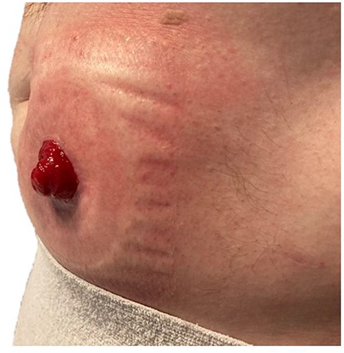 Ileostomy 1-year post-modified laparoscopic Sugarbaker repair of prolapse.