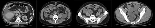 Axial slices of computed tomography scan showing a large volume of free fluid and free gas, with multiple sigmoid diverticula, reported as concerning for perforated sigmoid diverticula.