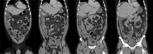 Coronal slices of computed tomography scan showing a large volume of free fluid and free gas, with multiple sigmoid diverticula, reported as concerning for perforated sigmoid diverticula.