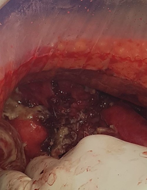 Intra-operative photo taken at the time of laparotomy showing gelatinous deposits.