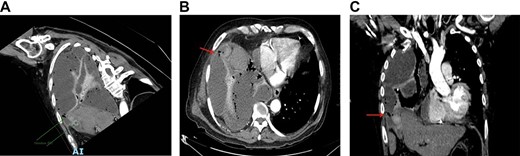 (A) Cholecystopleural fistula by contrast-enhanced thoracic CT. (B) Axial view that shows the perforation of the funds of the gallbladder with disruption of the right hemidiaphragm. (C) Coronal view that shows the perforation of the funds of the gallbladder with disruption of the right hemidiaphragm.