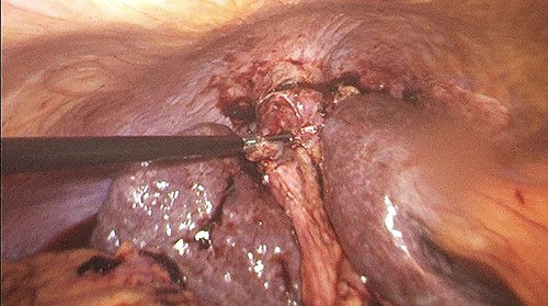 Gallbladder adhered to the diaphragm.