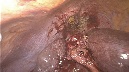 Fundus of the gallbladder adhered to the diaphragm after dissection.