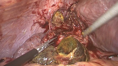Two stones removed from the fundus.