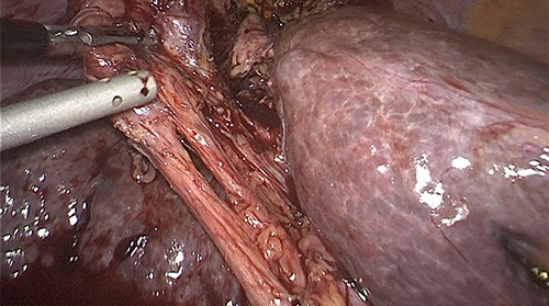 Cystic artery and cystic duct identified by using Strasberg’s critical view of safety.
