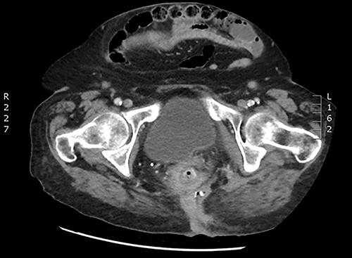 Axial plane CT demonstrating the infected mesh.