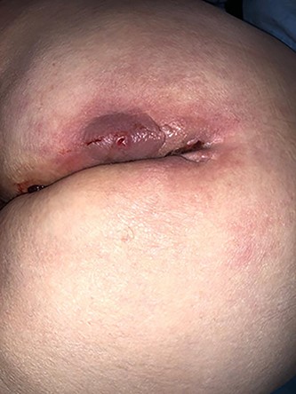 Image showing a buttock abscess.