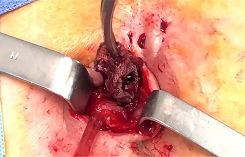 Abscess incision and mesh removal.