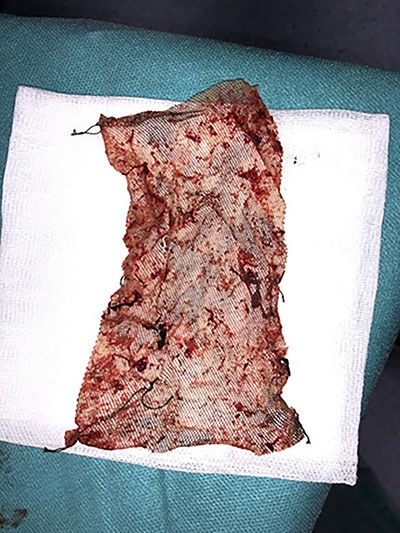 Image after a total mesh removal.