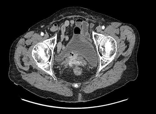 Axial plane CT showing infiltration around the mesh.