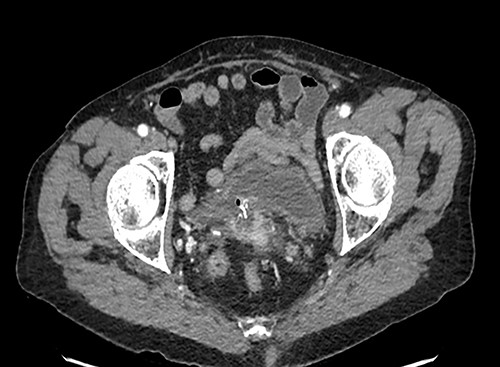 Axial plane CT showing the mesh migration into the bladder.