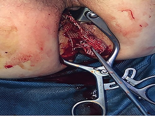 Mesh removal.