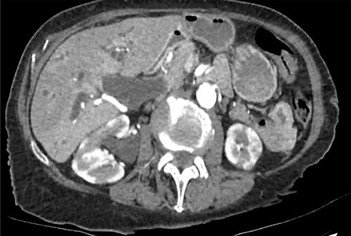CT abdomen—complete obstruction of mid-CBD, intra and extrahepatic biliary duct dilatation; no obstructing lesion identified; enlarged pancreas with abnormal enhancement and hypodense rind; diffuse hypodense wedge-shaped lesions in bilateral kidneys.