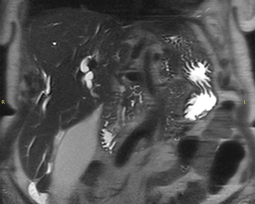 MRCP + pancreas—dilated intrahepatic biliary ducts and common bile duct with abrupt cut-off due to presence of a soft tissue mass highly suspicious for a cholangiocarcinoma; multifocal areas of heterogeneous signal and restricted diffusion in both kidneys may relate to IgG4 disease.