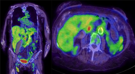 PET-CT whole body—focal increased uptake in the pancreatic head near the region of biliary tree amputation; increased heterogeneous uptake in the pancreas and kidneys; branching uptake in the right liver lobe suggesting vasculitis; extensive thoracic and abdominal aortic uptake indicating arteritis; other findings included prominent nodes with uptake in mediastinum, bilateral inguinal and external iliac.
