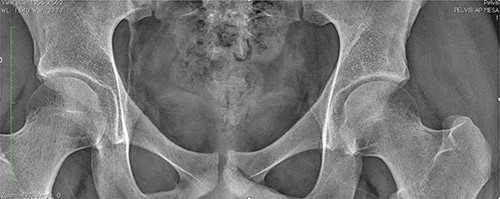 AP pelvis X-ray showing no sign of FAI or OO on the left hip.