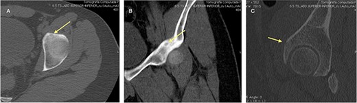 CT scan of the left hip showing a 6-mm extra-articular OO on the anterior rim of the acetabulum (yellow arrow).