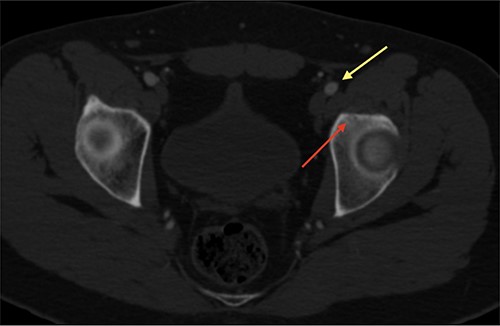 CT with intravenous contrast showing the femoral vessel (yellow arrow) before the procedure to obtain proper approach (red arrow showing the OO).