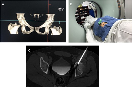 CT showing the precise site for needle insertion (A), CT control of the needle insertion (B,C).