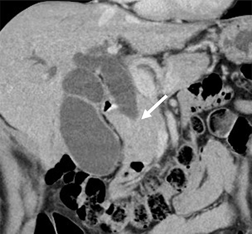 CT scan showed wall thickness and stenosis of the distal CBD (arrow).
