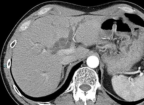 CT scan showed severe dilation of intrahepatic bile duct.