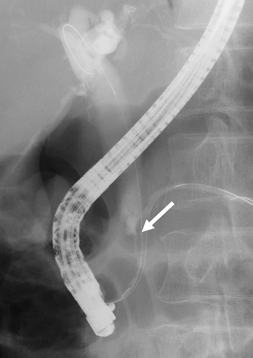 ERCP revealed irregular stricture of the distal CBD (arrow); brush cytology was performed at the same time.
