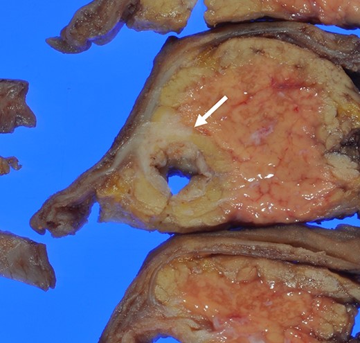 The surgical specimen showed a gray invasive nodular tumor measuring 19 × 18 × 15 mm at the distal CBD (arrow).