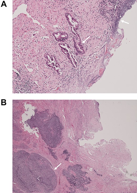 Pathological examination of the surgical specimen stained with hematoxylin and eosin; (A) well-differentiated adenocarcinoma at the CBD mucosa (arrow); (B) proliferation of small atypical cells forming follicular nests with invasion around the CBD wall (arrow).