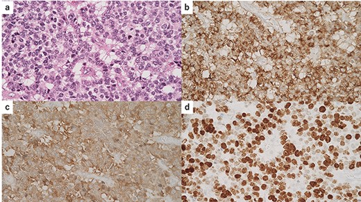 Immunohistochemical findings of the solid lesion of small atypical cells; (a) hematoxylin and eosin standing of the small atypical cells; (b) immunostaining for chromogranin A was positive; (c) immunostaining for synaptophysin was positive; (d) the Ki-67 index was ~80%.