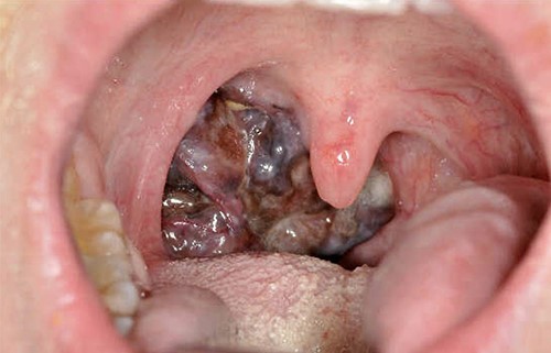 Mucosal melanoma of the right palatine tonsil.