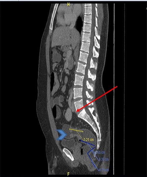 CT scan of the abdomen and pelvis (sagittal view) showing the upper rectal mass (arrowhead) with ectopic kidney (arrow).