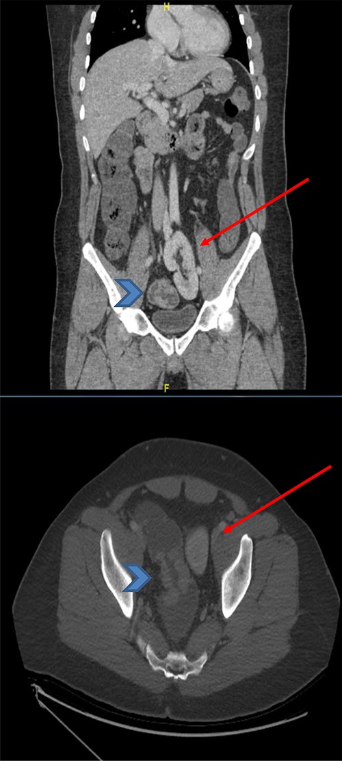 CT scan of the abdomen and pelvis (coronal and axial view) showing the upper rectal mass (arrowhead) with ectopic kidney (arrow), clear plane noted in-between without tumor invasion.
