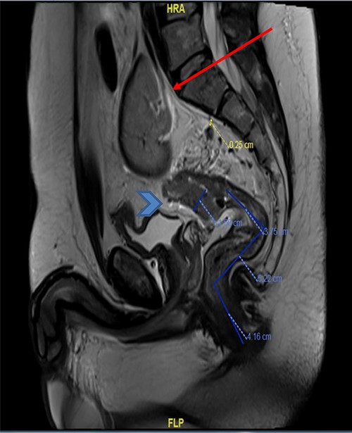 MRI pelvis (sagittal view) showed upper rectal mass with mesorectal fat involvement (arrowhead) and ectopic pelvic kidney (arrow).