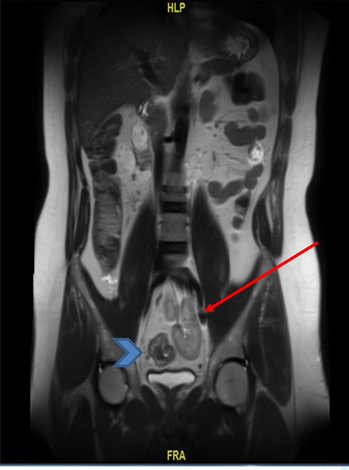MRI pelvis (coronal view) showed upper rectal mass with mesorectal fat involvement (arrowhead) and ectopic pelvic kidney (arrow).