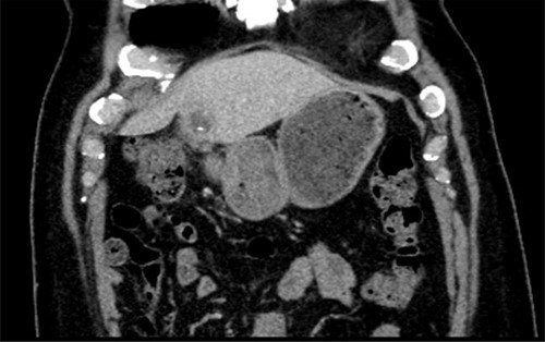 CT scan showing left lobe liver abscess with fishbone.